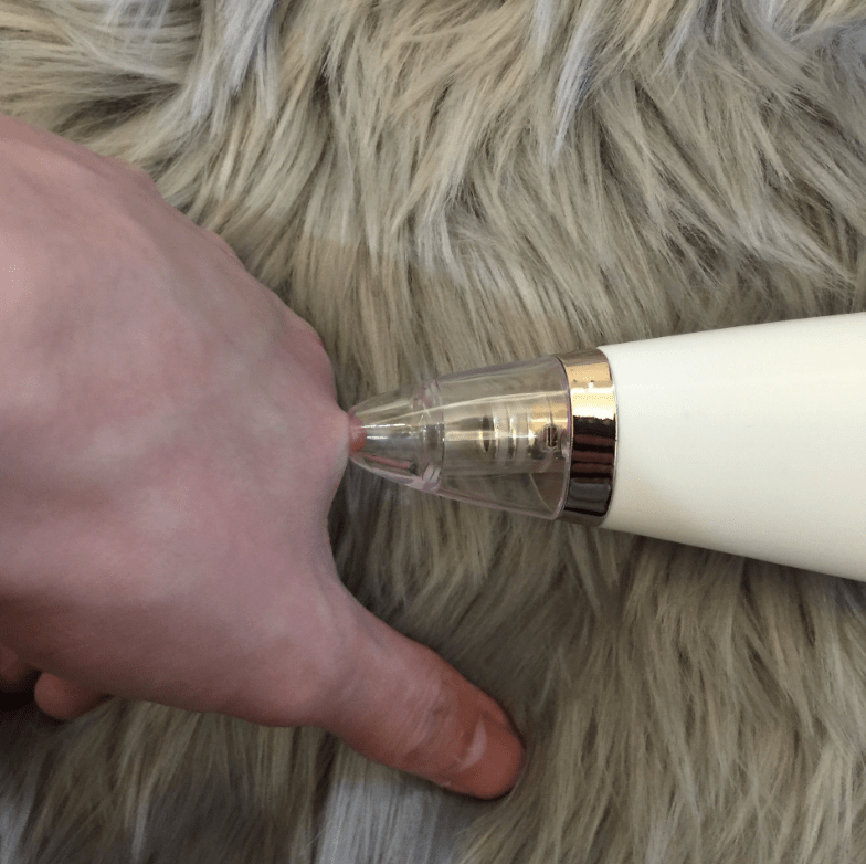 Blackhead Removal Device for Pore Cleansing and Skincare - luxebeautybar